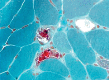 Imagen: Histología de una encefalopatía mitocondrial con fibras rojas rasgadas (Fotografía cortesía del Dr. K.K. Abu-Amero).